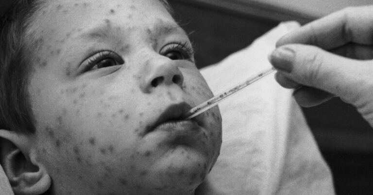 Chickenpox vaccine has almost wiped out severe illness from the virus