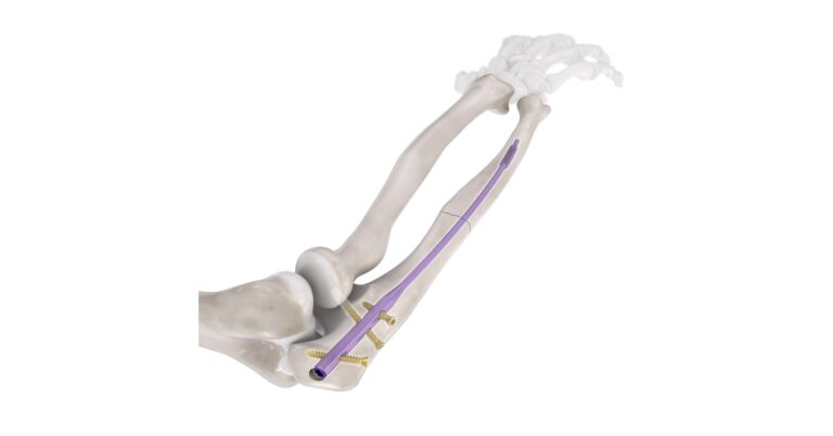 Conventus Flower Orthopedics Announces Expansion of its Flex-Thread™ Technology Platform with FDA Clearance of the Ulna Intramedullary Nail System